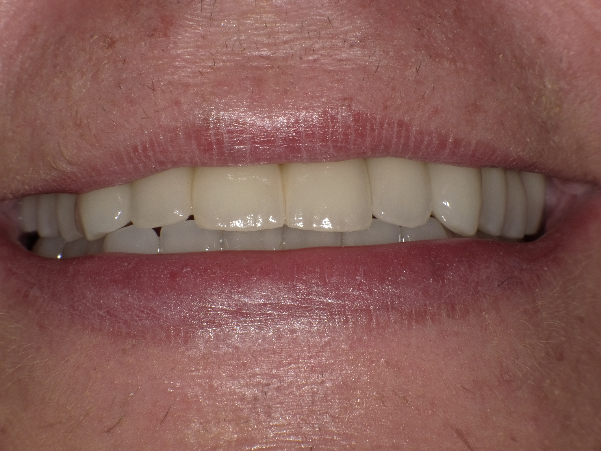 Ersatz der fehlenden Zähne mit Implantaten und Komplettversorgung mit vollkeramischen Restaurationen und Wiederherstellung der ursprünglichen Höhe